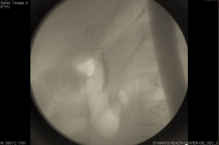 Surgical Clips Left On Common Bile Duct By Missouri Surgeon