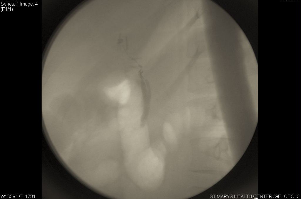 Surgical Clips Left On Common Bile Duct By Missouri Surgeon