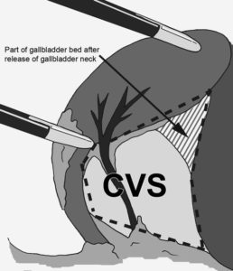 CVS gallbladder