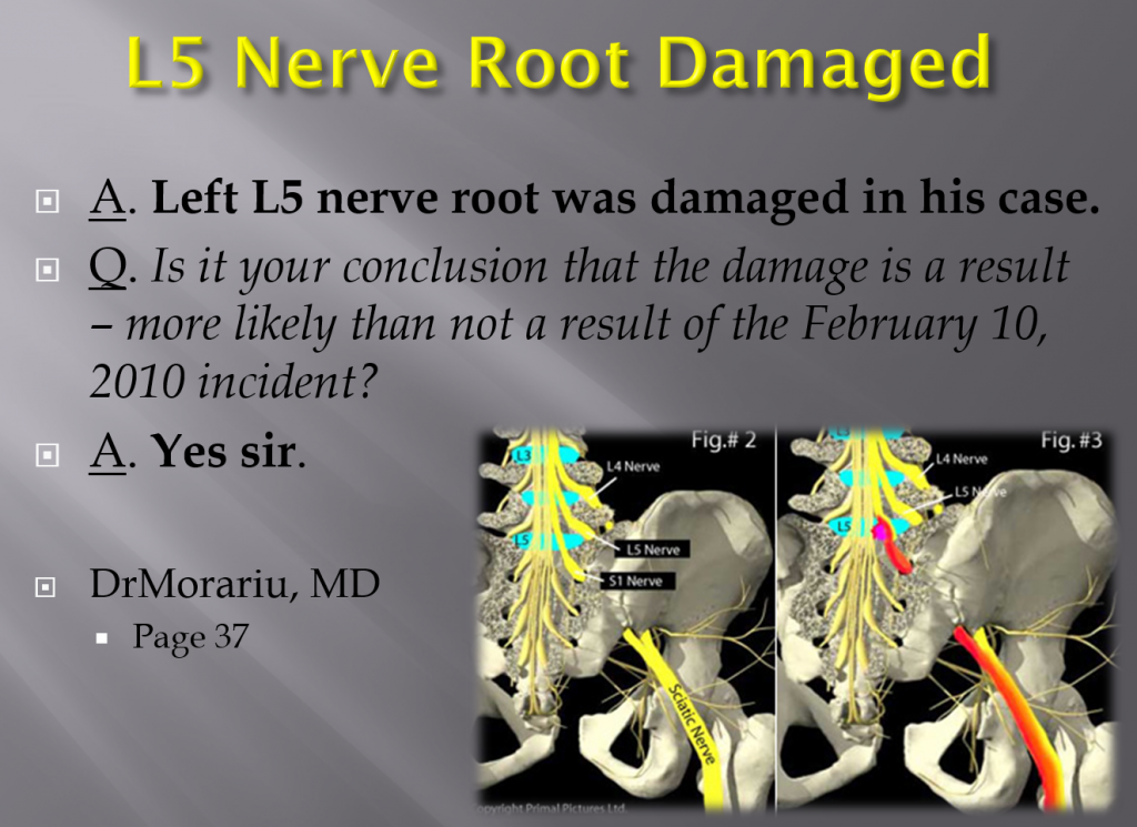 MRI Results - Nerve Injury Back Lawsuit Lawyer